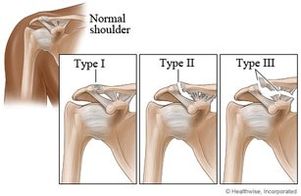 Dislocated clavicle treatment